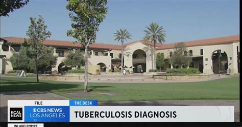 Riverside County resident tests positive for tuberculosis; 150 people may have been exposed
